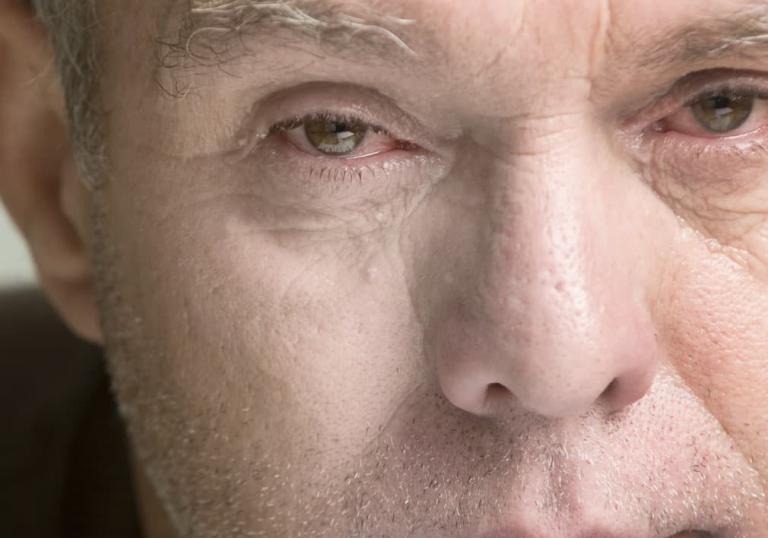 How to Get Rid of Drunken Eyes Ocean Recovery Centre