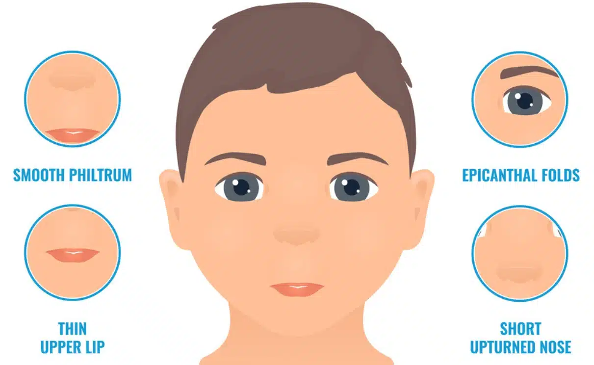 Fetal Alcohol Syndrome Eyes - An illustration of a child with FAS