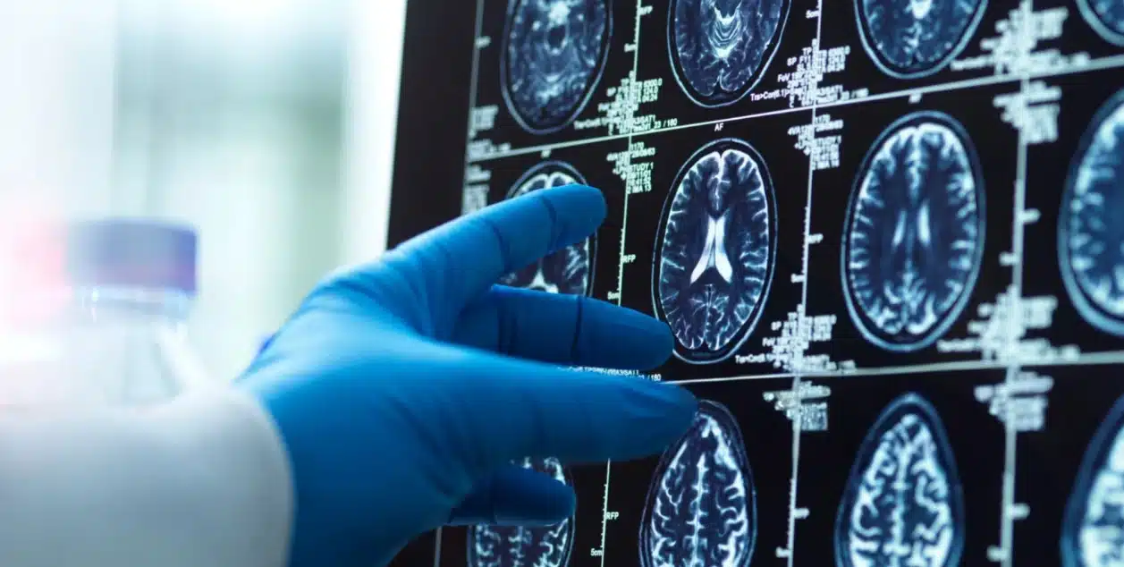 Can the Brain Recover from Alcohol Addiction? Image of brain scan